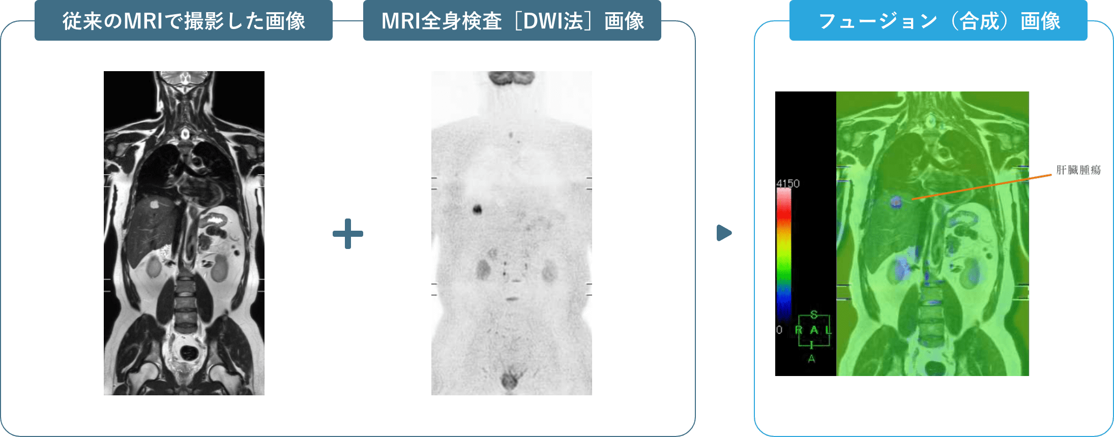 従来のMRIで撮影した画像＋MRI全身検査［DWI法］画像＝フュージョン（合成）画像